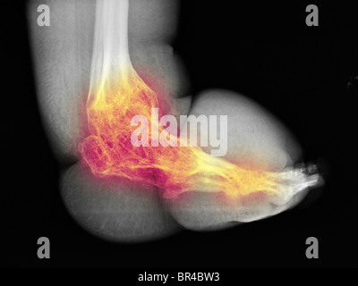 La gamba e il piede x-ray di 63 anno vecchio con la paraplegia e ampie variazioni degenerative e osteopenia Foto Stock