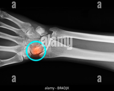 Mano x-ray mostra una frattura della navicular o osso scafoide del polso Foto Stock