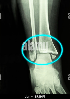 Raggi X che mostra un bimalleolar caviglia frattura in un anno 50 vecchia donna Foto Stock