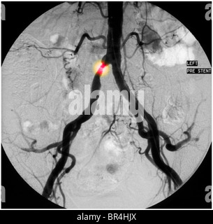 Angiogramma di 65 anno vecchio che mostra un'area di stenosi nel comune arteria iliaca Foto Stock