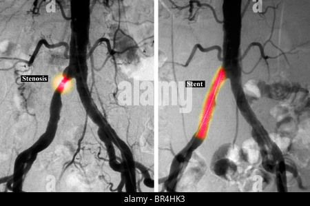 Angiogramma di 65 anno vecchio che mostra il posizionamento di uno stent nel comune arteria iliaca Foto Stock