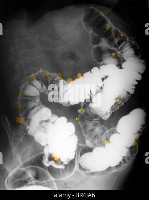 Addome x-ray del bario esame di contrasto che mostra la diverticolosi del colon di un 67 anno vecchia donna Foto Stock