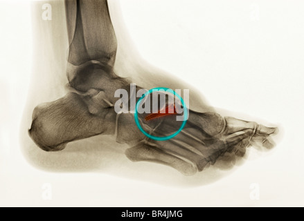 Piedi x-ray di 30 anno vecchio che aveva la chirurgia del primo metatarso con 2 viti di fusione del metatarso alla zona tarsica Foto Stock