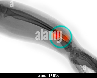 Avambraccio x-ray di un 9 anno vecchia ragazza che mostra di fratture distale di radio e ulna Foto Stock