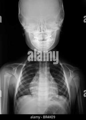 Il normale x-ray della testa e le spalle di un 3 anno vecchio ragazzo, raggi x della testa e del torace di un 3 anno vecchio ragazzo Foto Stock