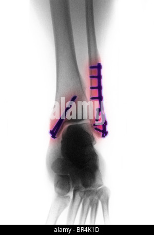 X-ray della caviglia di un 26 anno vecchio che mostra le viti e piastre utilizzate per la riparazione di una frattura e lussazione della caviglia Foto Stock