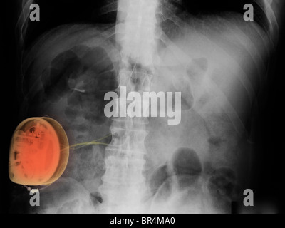 Raggi X che mostra un midollo spinale lo stimolatore utilizzati per trattare il dolore Foto Stock