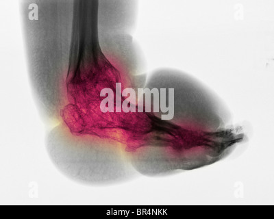 La gamba e il piede x-ray di 63 anno vecchio con la paraplegia e ampie variazioni degenerative e osteopenia Foto Stock