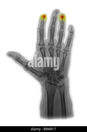 Mano x-ray mostra schiacciato polpastrelli, mano raggi x che mostra le fratture della falange distale dell'indice e l'anello dita Foto Stock