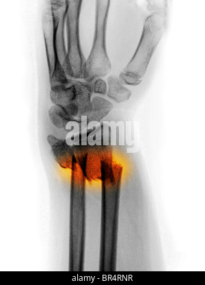 Spostato radio e ulna avambraccio una frattura in un 12 anni ragazza Foto Stock