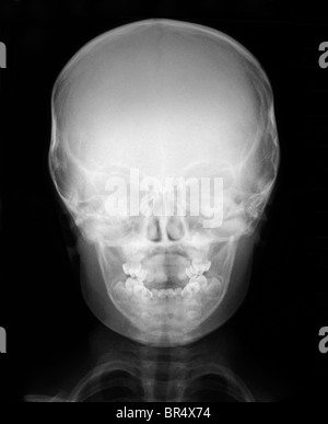 Il normale x-ray della testa di un bambino di 3 anni ragazzo, raggi x della testa e del torace di un 3 anno vecchio ragazzo Foto Stock