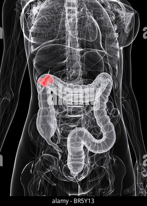 tumore del colon Foto Stock