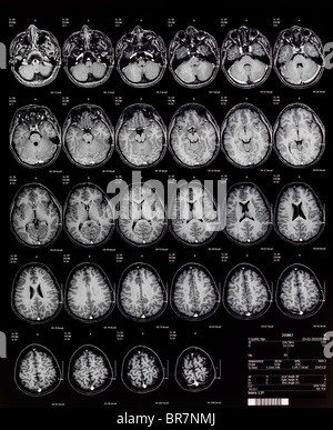 I bambini del cervello MRI magnetic resonance imaging o NMRI il rilevamento di immagini in risonanza magnetica nucleare di Foto Stock