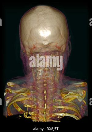 3D CT scan della testa di un uomo anziano Foto Stock