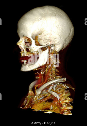 3D CT scan della testa di un uomo anziano Foto Stock