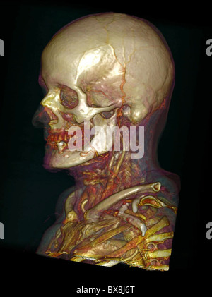 3D CT scan della testa di un uomo anziano Foto Stock