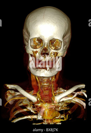 3D CT scan della testa di un uomo anziano Foto Stock