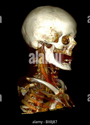 3D CT scan della testa di un uomo anziano Foto Stock