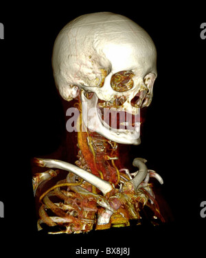 3D CT scan della testa di un uomo anziano Foto Stock