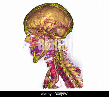 3D CT scan della testa di un uomo anziano Foto Stock