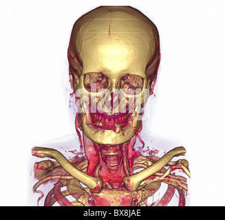 3D CT scan della testa di un uomo anziano Foto Stock