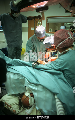 I chirurghi esegue chirurgia a cuore aperto durante una procedura presso la struttura sanitaria privata International Hospital. Foto Stock
