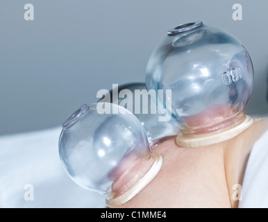 L'applicazione di Terapia cupping nella medicina tradizionale cinese per l'uomo della spalla Foto Stock