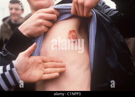 Rioter adolescente Belfast 1981. The Troubles 1980s mostra una ferita ricevuta da un proiettile di gomma sparato da soldati britannici a giovani in rivolta nel Regno Unito HOMER SYKES del 1980 Foto Stock