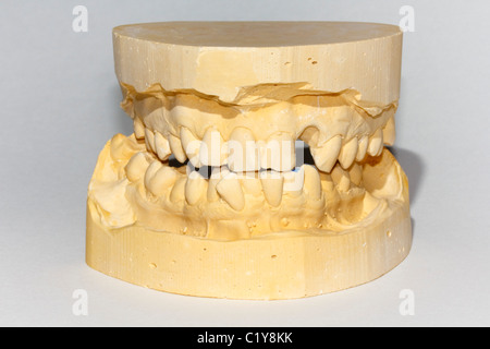 Calco in gesso dente dentale editoriale per la realizzazione di dentiera. Foto Stock