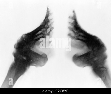 X-ray dei piedi legati, Cina circa 1920 Foto Stock