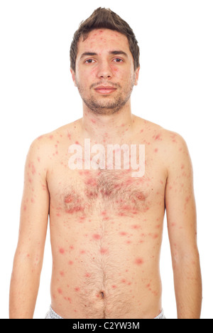 Giovane uomo avente la varicella isolati su sfondo bianco Foto Stock