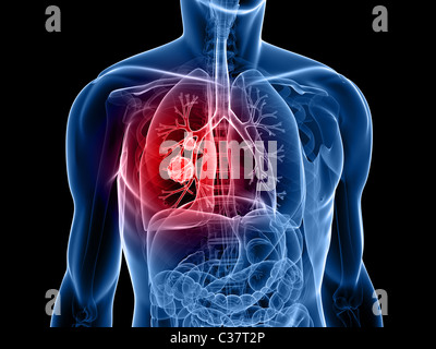 cancro del polmone Foto Stock