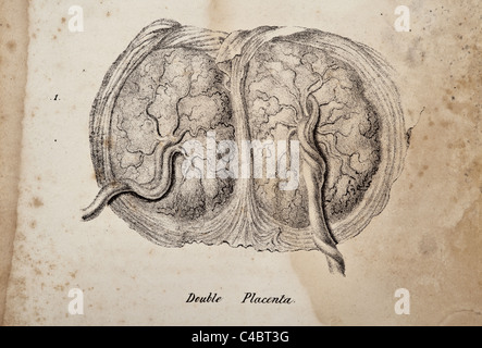 Illustrazione della placenta umana copyright 1844 Foto Stock