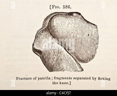 Antica Illustrazione medica della rotula circa 1881 Foto Stock