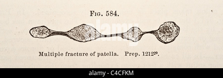 Antica Illustrazione medica della rotula circa 1881 Foto Stock