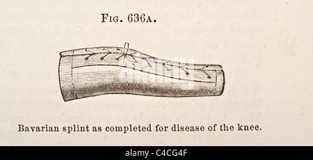 Antica Illustrazione medica della stecca per trattare Knee-Joint malattie correlate circa 1881 Foto Stock