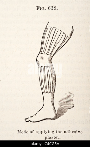 Antica Illustrazione medica della stecca per trattare Knee-Joint malattie correlate circa 1881 Foto Stock