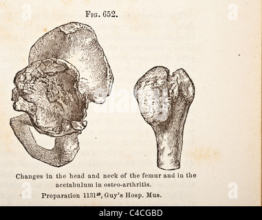 Antica Illustrazione medica di osteoartrite circa 1881 Foto Stock