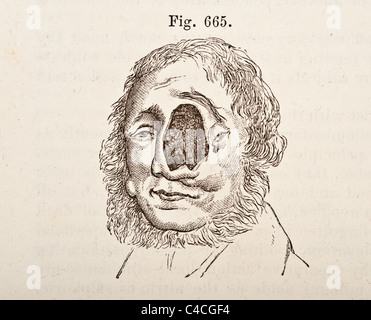 Antica Illustrazione medica dei tumori di osso risalente al 1881 Foto Stock