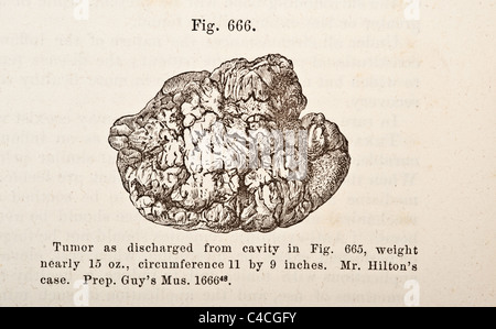 Antica Illustrazione medica dei tumori di osso risalente al 1881 Foto Stock