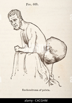 Antica Illustrazione medica dei tumori di osso risalente al 1881 Foto Stock