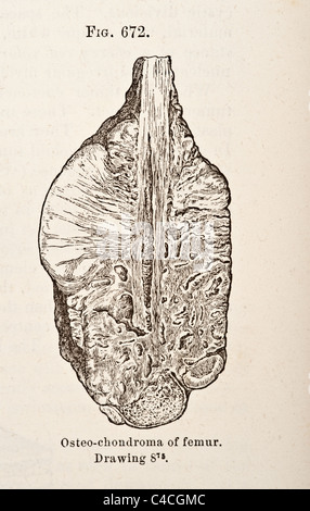 Antica Illustrazione medica dei tumori di osso risalente al 1881 Foto Stock