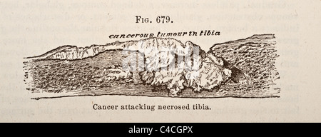 Antica Illustrazione medica dei tumori di osso risalente al 1881 Foto Stock