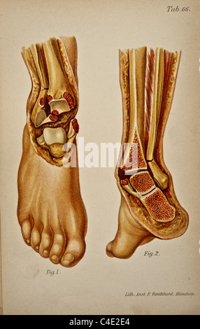 Illustrazione della caviglia umana copyright 1902 Foto Stock