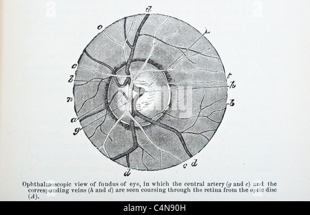 Antica Illustrazione medica della malattia oculare e chirurgia oftalmologici Foto Stock