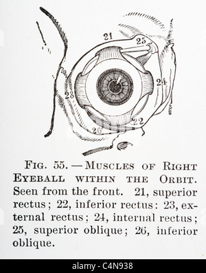 Antica Illustrazione medica della malattia oculare e chirurgia oftalmologici Foto Stock