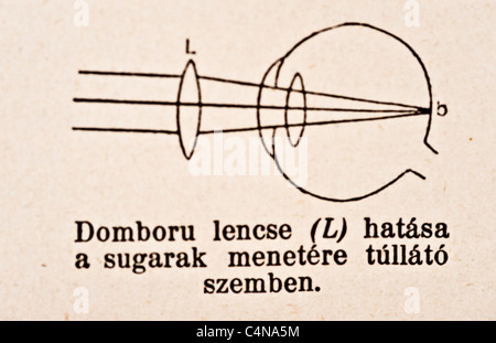 Antica Illustrazione medica della malattia oculare e chirurgia oftalmologici Foto Stock