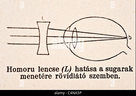 Antica Illustrazione medica della malattia oculare e chirurgia oftalmologici Foto Stock