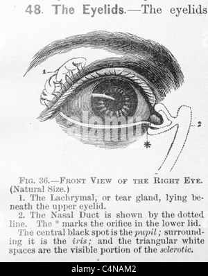 Antica Illustrazione medica della malattia oculare e chirurgia oftalmologici Foto Stock