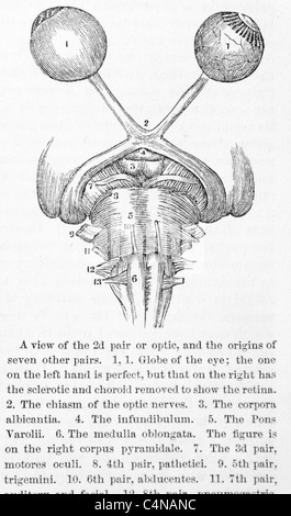 Antica Illustrazione medica della malattia oculare e chirurgia oftalmologici Foto Stock